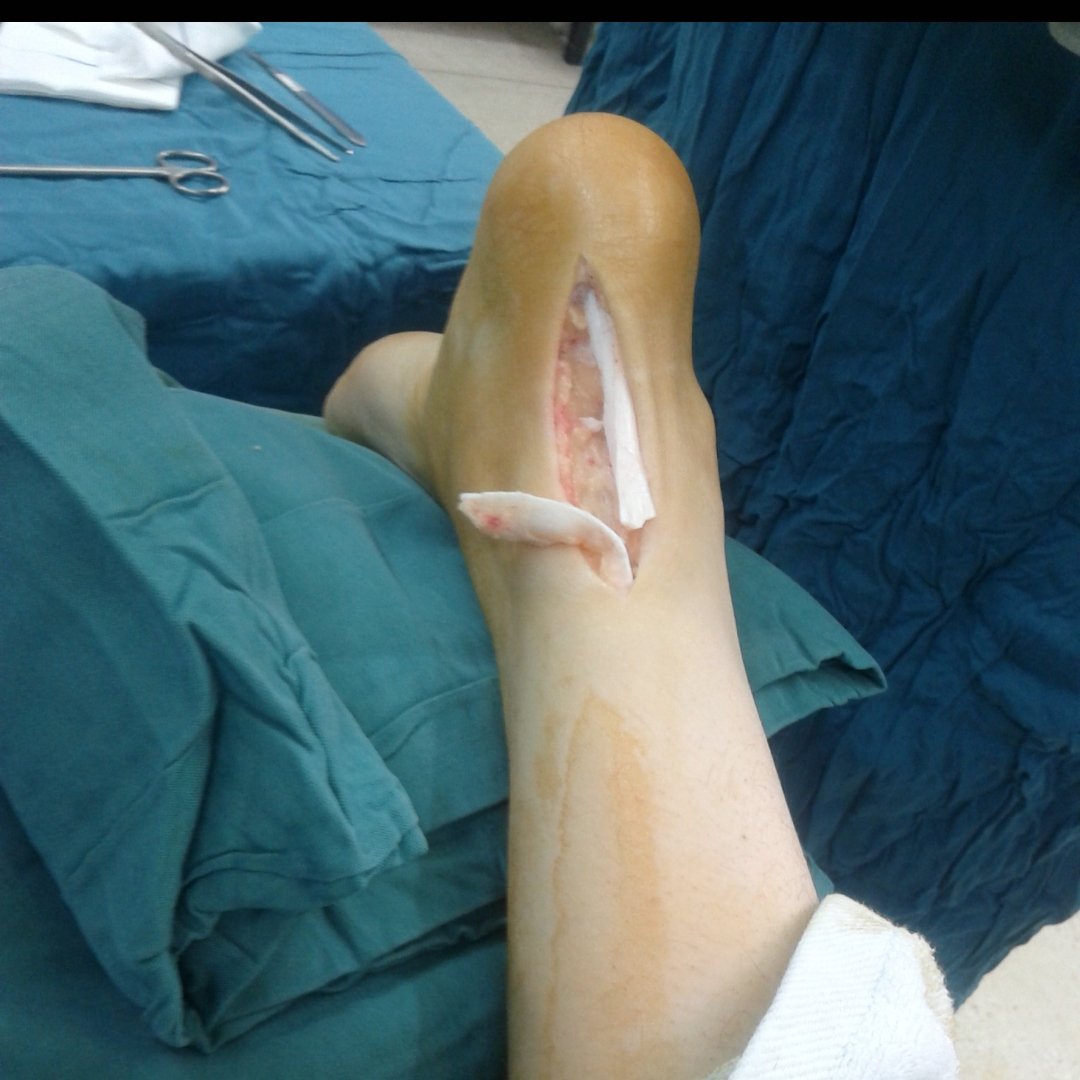 For those that like taking Cipro everytime for Malaria &amp; Typhoid, Taking cipro like TomTom

You wake up one morning with leg pain &amp; you can't walk; you think it is Spiritual. 
No it is not.  It is Cipro

Abusing Cipro can cause a tear or rupture of your Achilles tendon (pic)