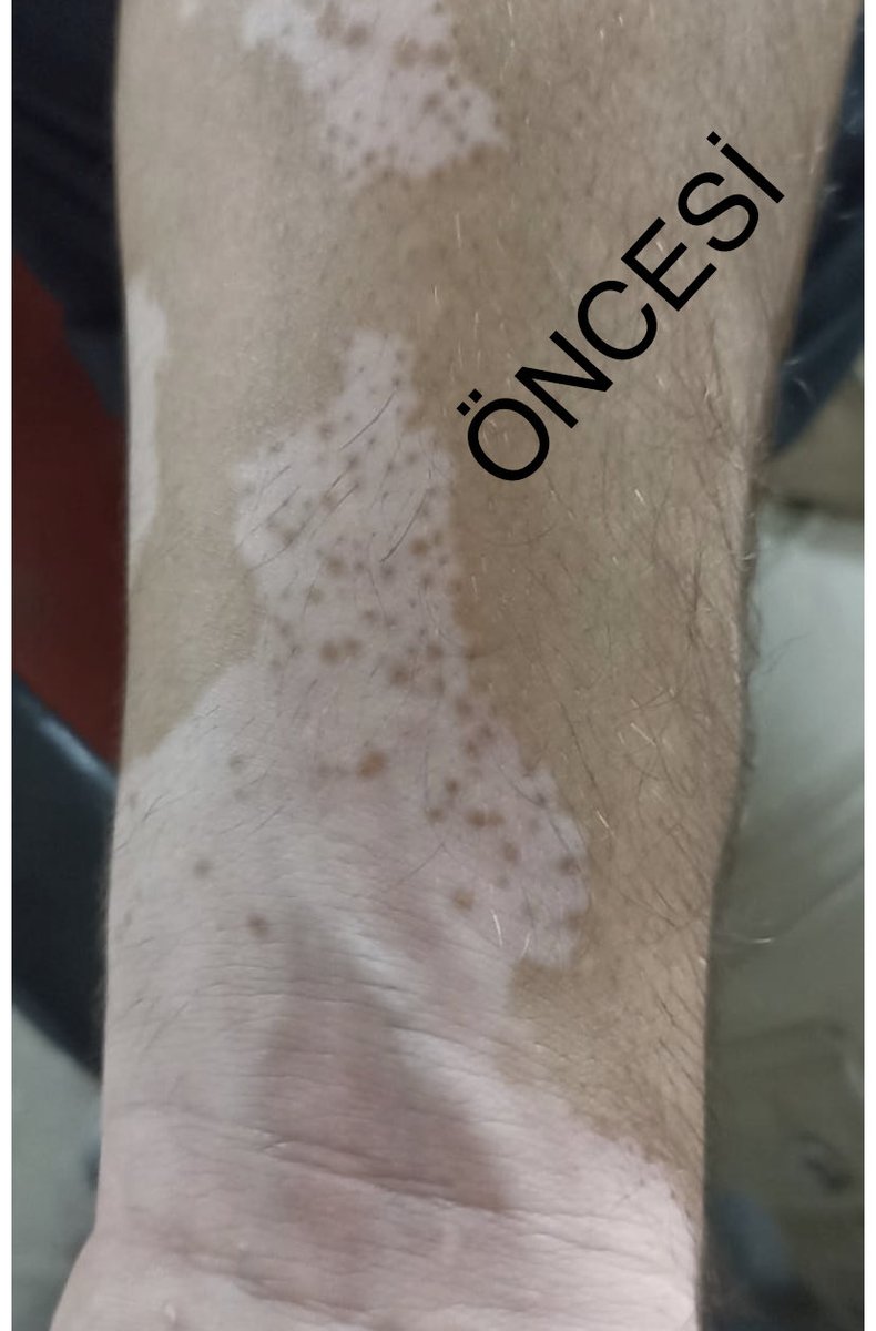 2 aylık kısa bir sürede gerçekleşen değişiklik.  ( Vitiligo hastalığı