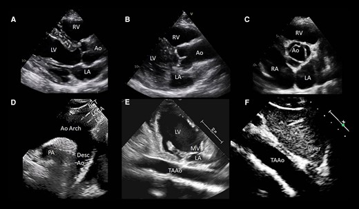 TTE of the aorta: the essential views
academic.oup.com/ehjcimaging/ar…
Follow us for more educational posts on EACVI guidelines for Echocardiography. Enhance your knowledge &stay updated with the latest practices. #EACVI #Echocardiography #CardiovascularImaging #KnowYourGuidelines