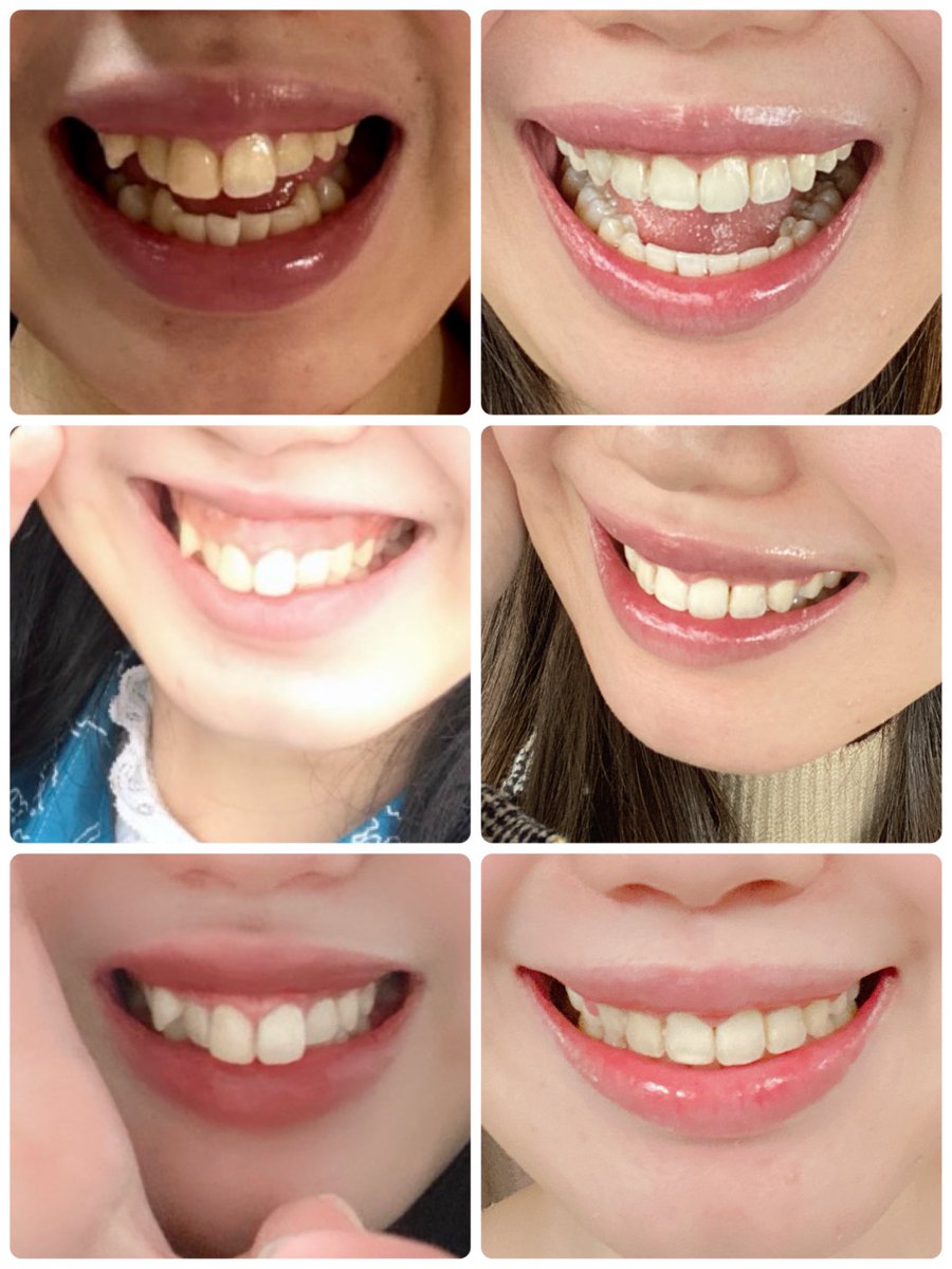 ←before   after→

出っ歯も八重歯もガミーも改善されてこんな綺麗な歯並びにしてもらって、矯正歯科と口腔外科の先生たちには感謝しかない😭歯列矯正して本当によかった❤️‍🩹