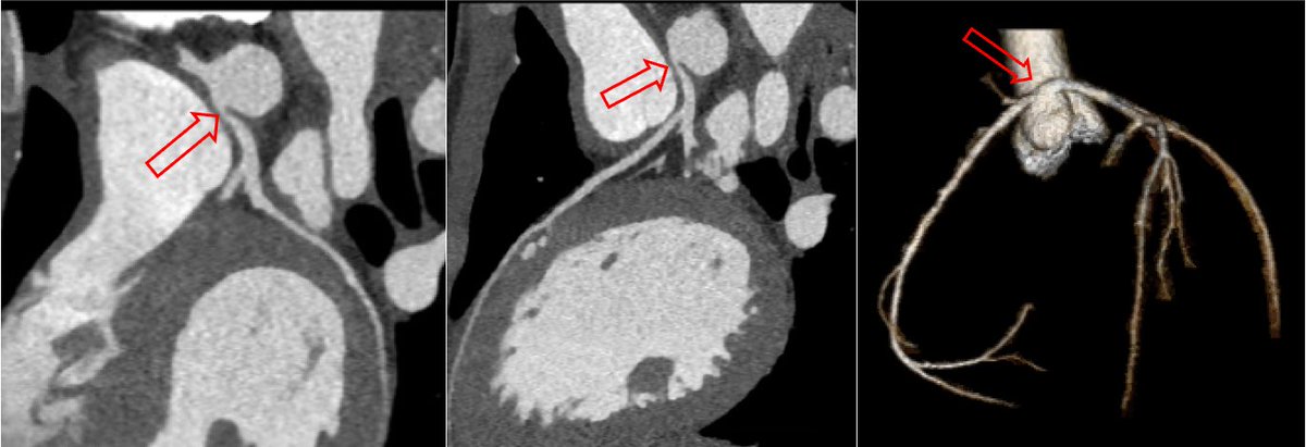 SICSPORT1's tweet photo. #CaseOfTheWeek 🩺
“SYNCOPE IN A YOUNG ATHLETE”
14-year-old male without significant past medical history presented to the Emergency Department for further evaluation after a syncopal episode…
👇🏽
https://t.co/Gm8VJSbQ7n https://t.co/u7MUvHKZrE