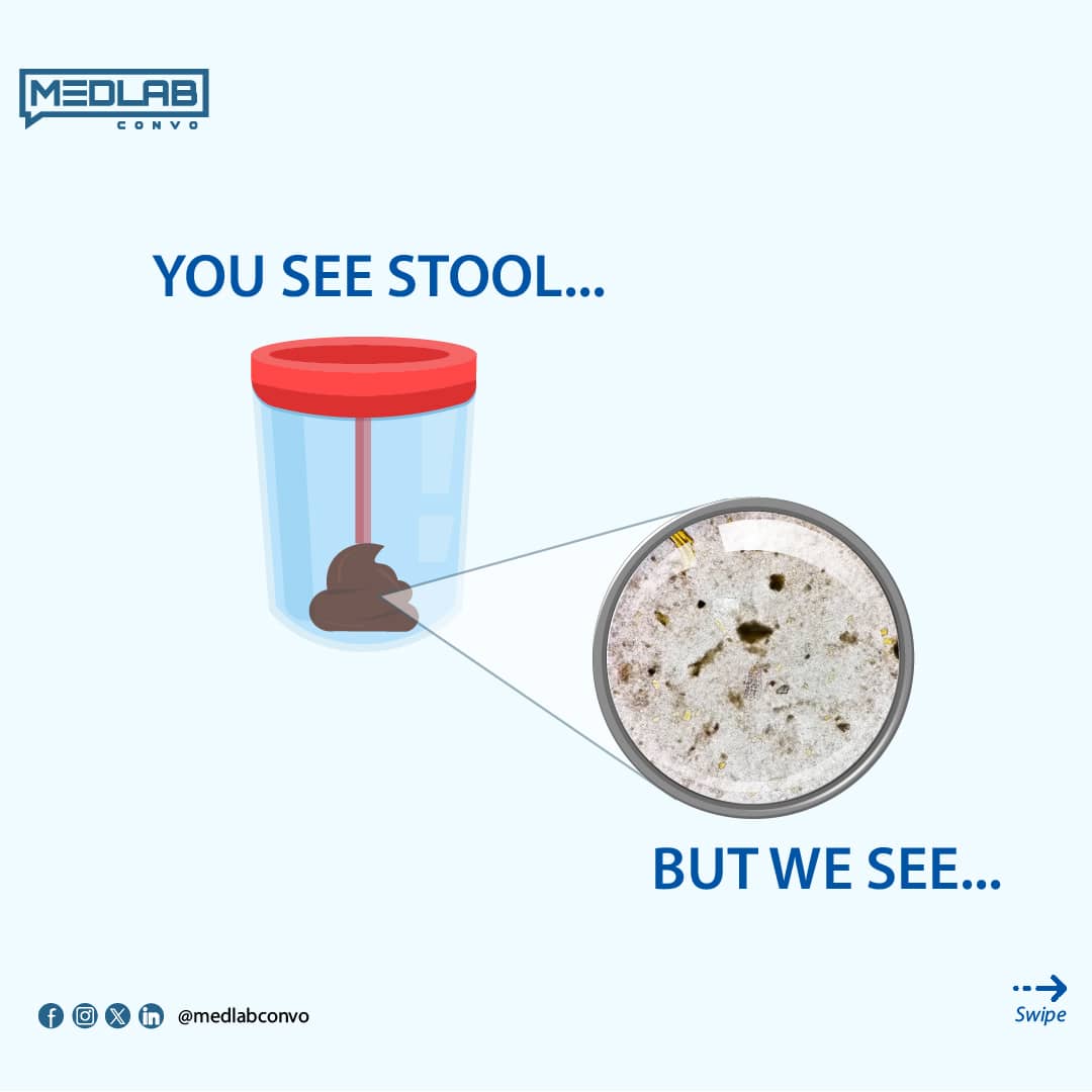 Medlabconvo's tweet photo. IT IS MORE THAN JUST STOOL TO US!
You walk into the hospital, asked to go run a test and you were asked to bring your stool.
What for? You might have wondered, well once again, this is what we see!
#StoolAnalysis #MLSTwitterCommunity #LetsTalkMedLab #MondayMood https://t.co/FkKGhFxpBj