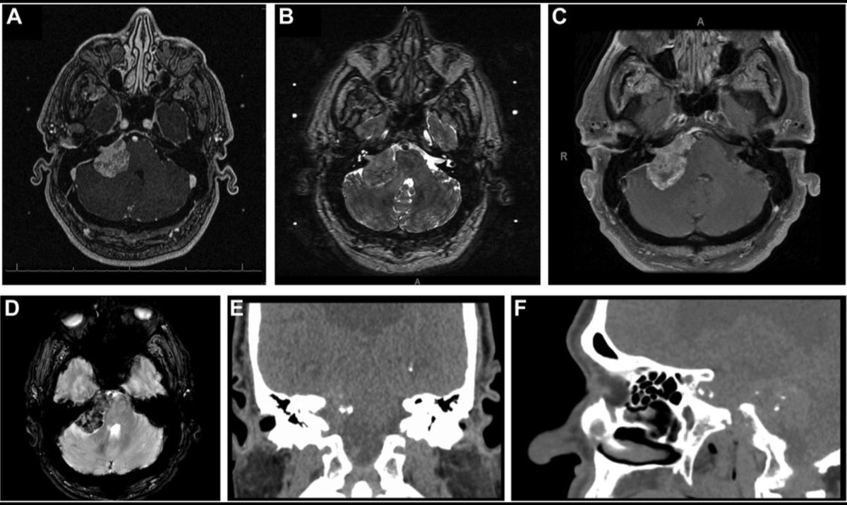 Neurosurgery Publications (@neurosurgerycns) on Twitter photo #NEUNew Intratumoral Hemorrhage in Vestibular #Schwannomas After Stereotactic Radiosurgery: Multi-Institutional Study bit.ly/3HFgitv by <a href="/Obinalamer/">Othman Bin-Alamer</a> <a href="/UPMC/">UPMC</a> <a href="/haboualshaar/">Hussam Abou-Al-Shaar</a> <a href="/hadjiMDPhD/">Costas Hadjipanayis</a> <a href="/CNS_Update/">CNS</a> <a href="/DKondziolkaCNS/">Douglas Kondziolka</a> <a href="/IsaacYangMD/">Isaac Yang MD</a> #NEUNew Intratumoral Hemorrhage in Vestibular #Schwannomas After Stereotactic Radiosurgery: Multi-Institutional Study bit.ly/3HFgitv by <a href="/Obinalamer/">Othman Bin-Alamer</a> <a href="/UPMC/">UPMC</a> <a href="/haboualshaar/">Hussam Abou-Al-Shaar</a> <a href="/hadjiMDPhD/">Costas Hadjipanayis</a> <a href="/CNS_Update/">CNS</a> <a href="/DKondziolkaCNS/">Douglas Kondziolka</a> <a href="/IsaacYangMD/">Isaac Yang MD</a>