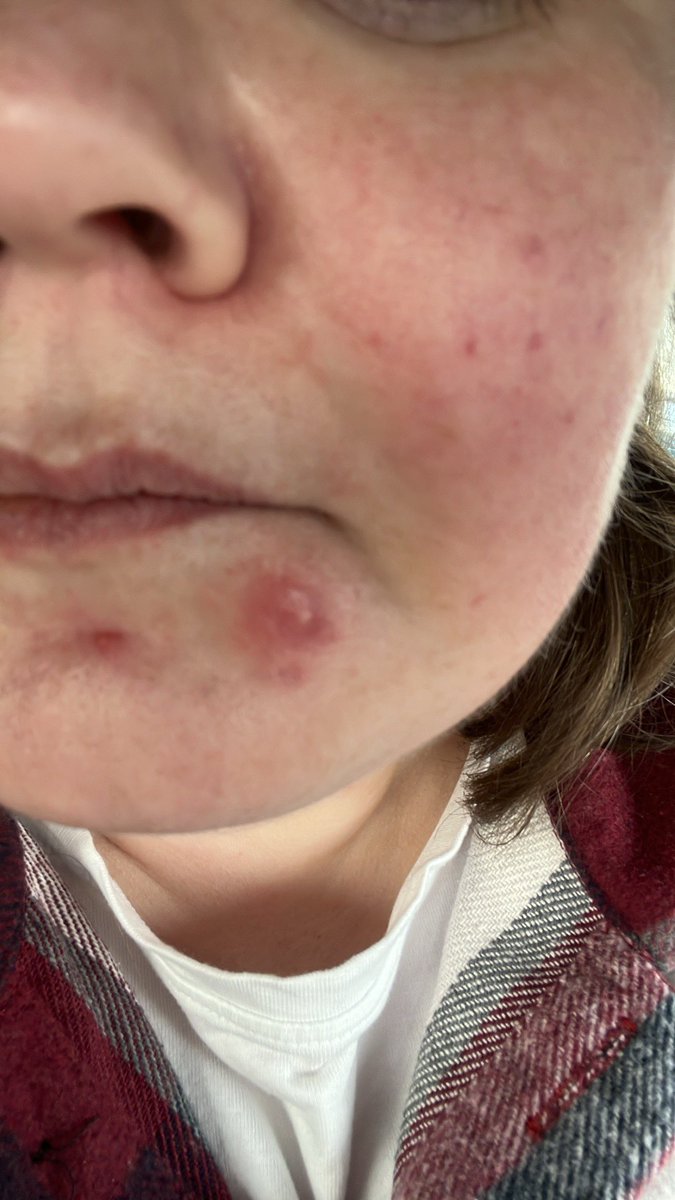 Rachelina16's tweet image. #Staphylococcusaureus #infection #skin
Used salt water for cleaning, magnesium paste, Germolene. Nothing. GP prescribing #Flucloxacillin
Interesting my mental health declined last few days too. Similarly to #PANS #PANDAS but symptoms not so extreme.