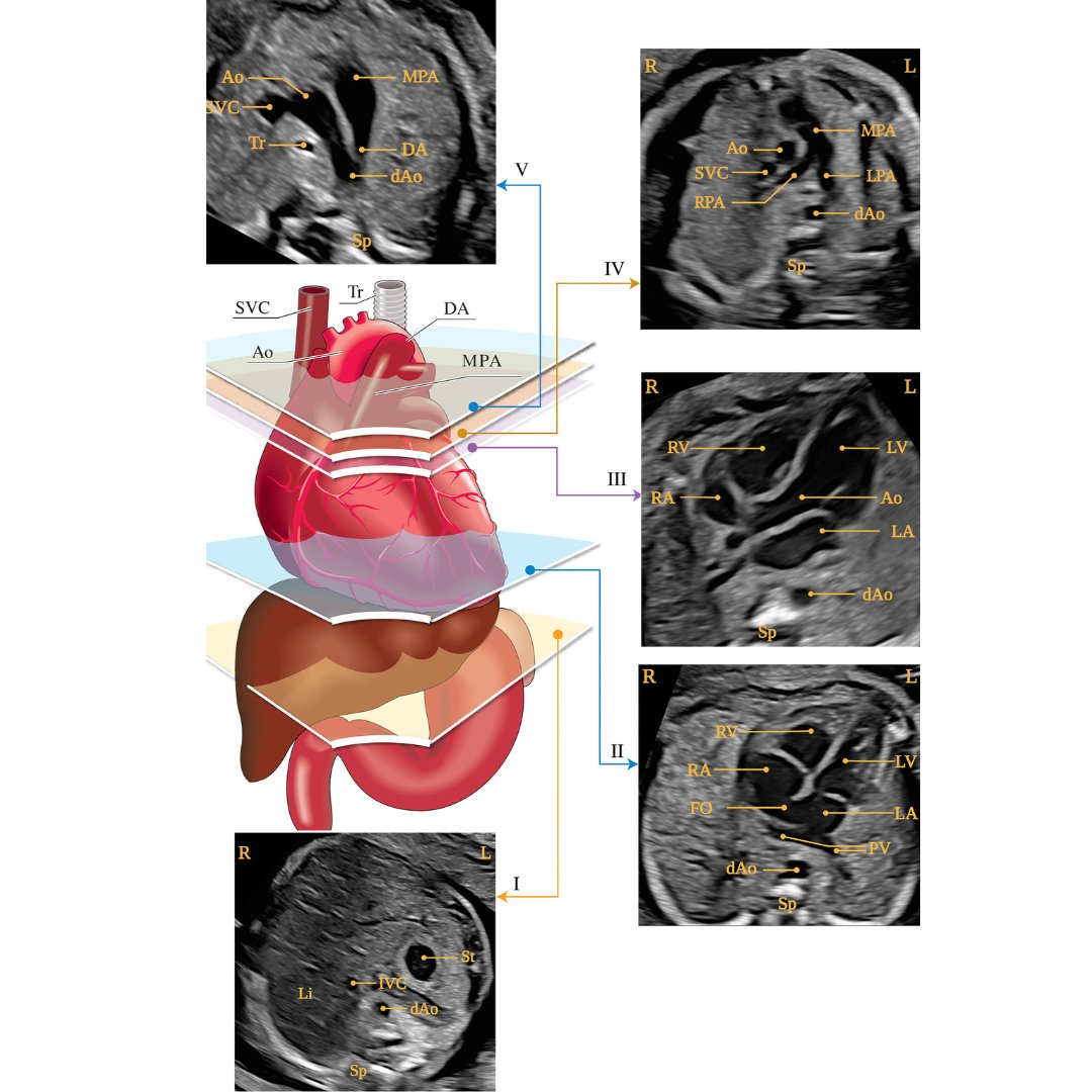 ISUOG's tweet photo. In a new #UOGJournal article, Dr. DeVore discusses enhancement of fetal cardiac screening as proposed by the ISUOG Practice Guidelines: https://t.co/u6qwC13hir. Watch the accompanying multimedia tutorial here: https://t.co/YlQtmfQ0CT https://t.co/DQudL8Pvmw