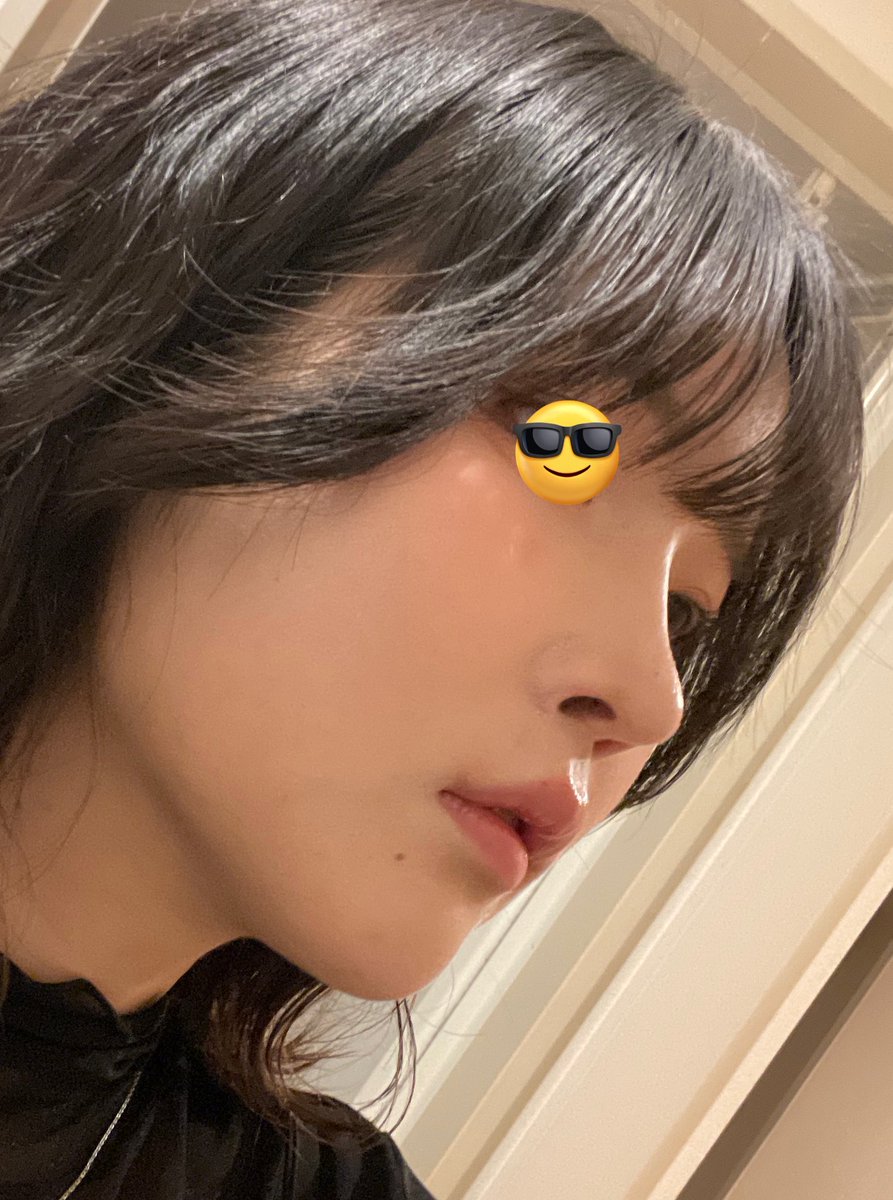 mochimarumemo's tweet photo. アーバンでやった鼻整形(➕その他諸々)9ヶ月経過！
感染も炎症もなく鼻整形したことを忘れるくらいナチュラルで綺麗🫶
でもbeforeと比べるとびっくりするくらい変化あって感謝しかない🥹👍🏻 https://t.co/PYTcflFtgG
