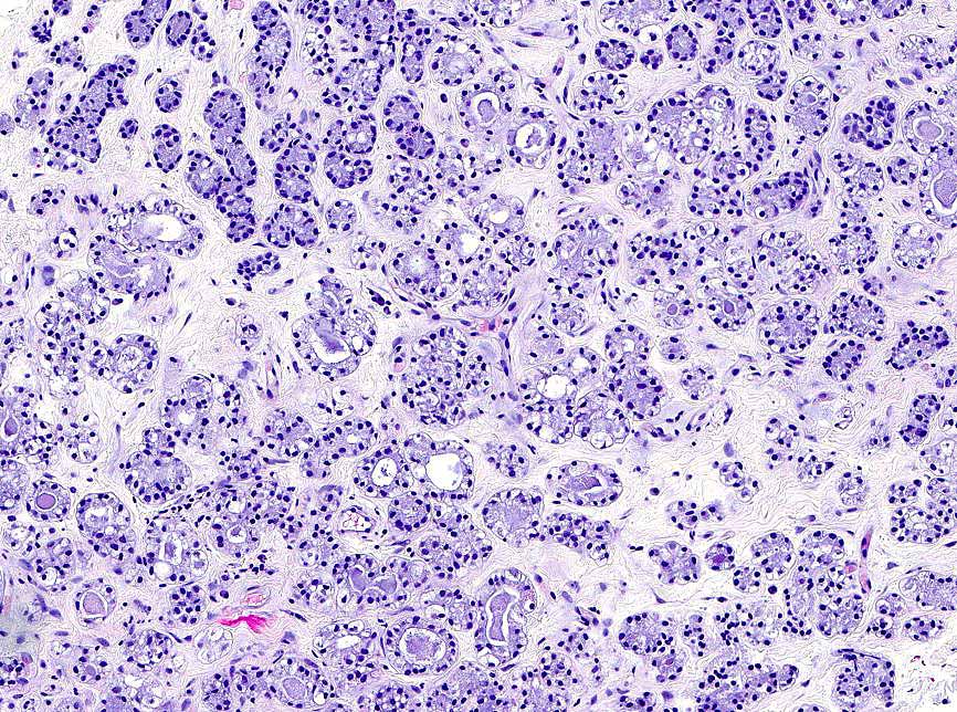 LizMontgomeryMD's tweet photo. Stellar case from  Dr. @ErikAWilliamsM1 . Eccrine cutaneous mixed tumor. Sections show ducts in a fibromyxoid stroma. Sequencing reveals a SOX10 internal tandem duplication in the transactivation domain (SOX10 p.L301_P302ins28). Newly described in PMID: 38266920.#UMiamiPath https://t.co/knja3uMwpy