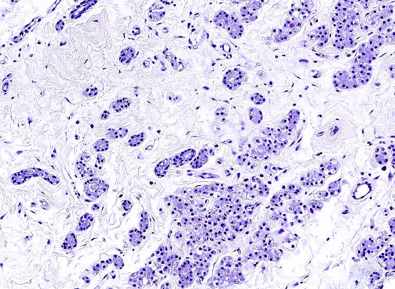LizMontgomeryMD's tweet photo. Stellar case from  Dr. @ErikAWilliamsM1 . Eccrine cutaneous mixed tumor. Sections show ducts in a fibromyxoid stroma. Sequencing reveals a SOX10 internal tandem duplication in the transactivation domain (SOX10 p.L301_P302ins28). Newly described in PMID: 38266920.#UMiamiPath https://t.co/knja3uMwpy