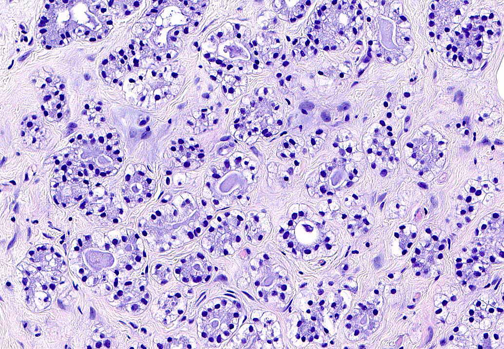 LizMontgomeryMD's tweet photo. Stellar case from  Dr. @ErikAWilliamsM1 . Eccrine cutaneous mixed tumor. Sections show ducts in a fibromyxoid stroma. Sequencing reveals a SOX10 internal tandem duplication in the transactivation domain (SOX10 p.L301_P302ins28). Newly described in PMID: 38266920.#UMiamiPath https://t.co/knja3uMwpy