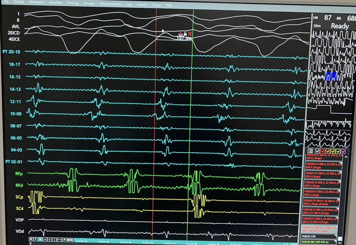 Monomorphic VT and Mid-diastolic epicardial potential in Brugada Syndrome patient! @Dr_Santangeli @LuigiDiBiaseMD @DrRoderickTung @leorothlisbergr @Scanav1Mauricio @CarinaHardy4