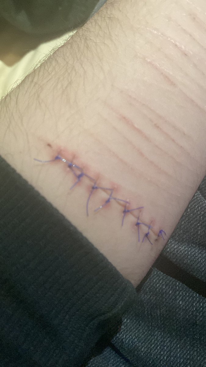zyzyucidio's tweet photo. This is how the previous cut ended (It looks infected but it is healing) https://t.co/boOnQrDUyz