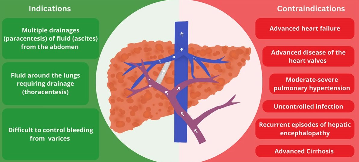 Tips for TIPS! A patient-focused review on indications, procedure considerations, monitoring and many common questions patients often ask about TIPS. A great article to share with your patients who are considering TIPS! @justinboike journals.lww.com/cld/pages/arti…