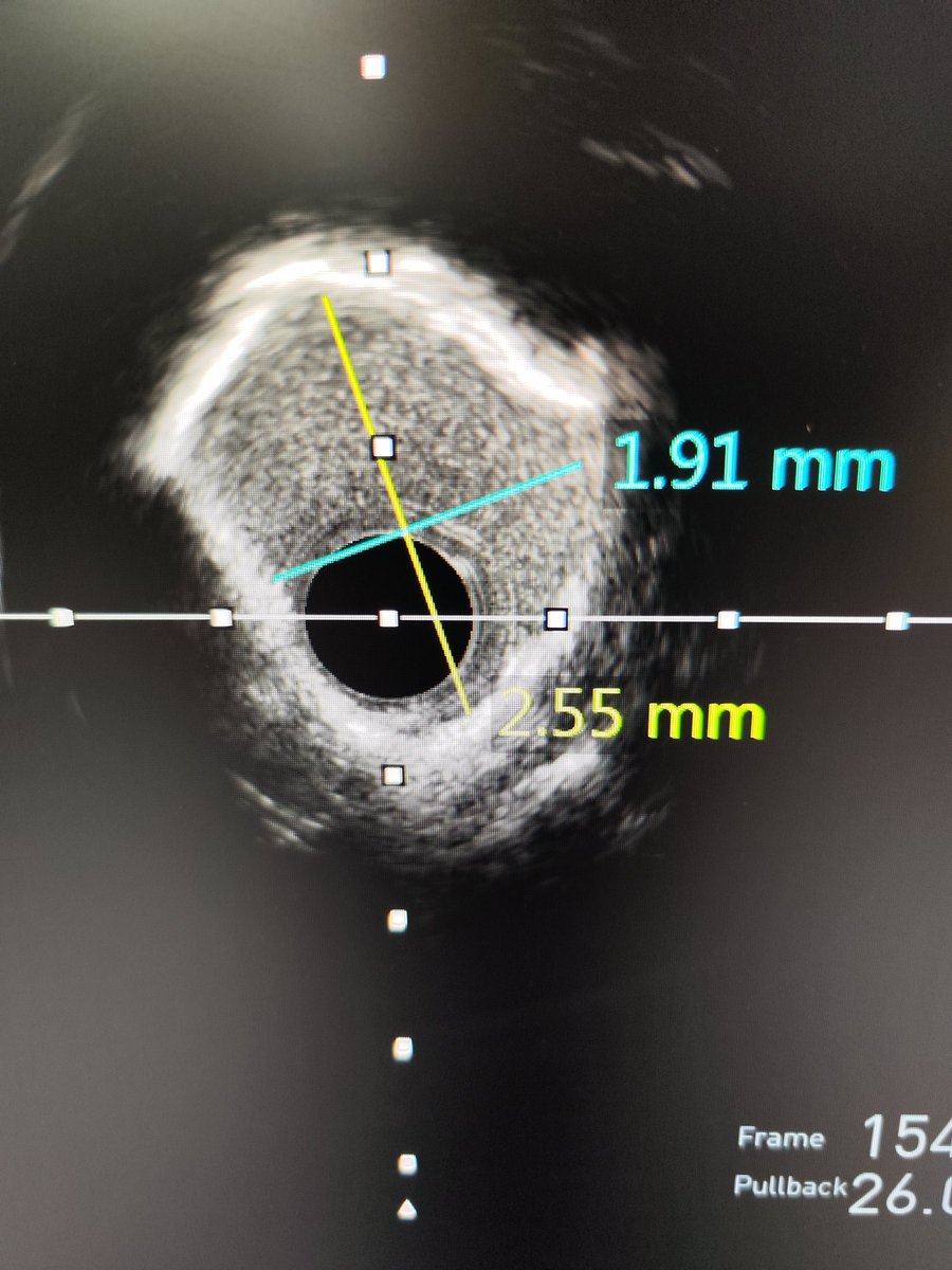 MarekRadomski71's tweet photo. #IVL #Shockwave #LMPCI #CHIP Intravascular lithotripsy works... First 5 cases done. We are impressed how effective it was. IVUS HD #OptiCross shows calcified ring ruptures. https://t.co/pYE7UxzVQU