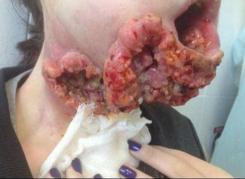Tanatofobiaaaa's tweet photo. Este es un caso de carcinoma avanzado de células escamosas, un tumor epitelial maligno que puede desarrollarse en el cuello uterino, cavidad oral, esófago, cabeza y cuello, pulmones nariz y piel. https://t.co/AjFS6OdTp9