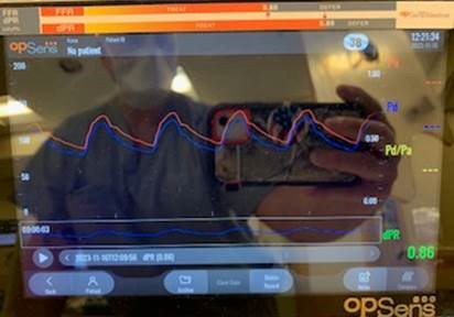 HAEQuebec's tweet image. Cas #OptoWire au CMC avec le Dr Stephan Heo, qui a mis l'OptoWire à l'épreuve dans une LAD très tortueuse, déconnectant le connecteur pour une performance optimale. dPR du patient 0,86 (mid-LAD), 0,89 (CX), CTO dans la RCA, ce qui l'a conduit à une référence pour un pontage