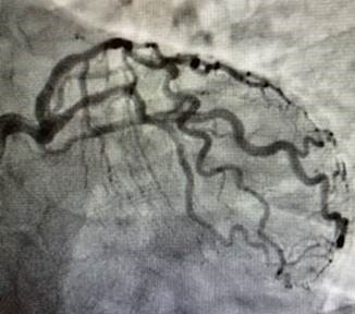 HAEQuebec's tweet image. #OptoWire case at CMC with Dr. Stephan Heo. Dr. Heo took OptoWire through its paces in a very tortuous LAD, disconnecting the connector for optimal performance. The patient recorded a dPR of 0.86 (mid-LAD), 0.89 (CX), and had a CTO in the RCA, resulting in a referral for CABG.