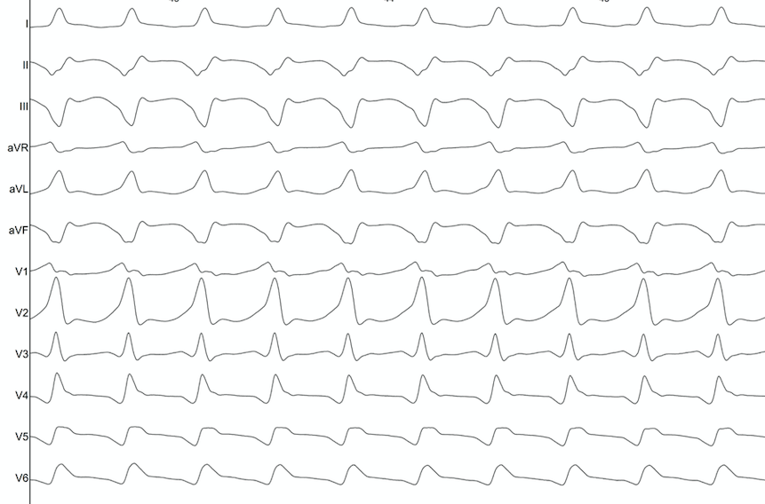 PSanchezSomonte's tweet photo. Starting Monday with a nice VT. Inferior scar. Hidden slow conduction unmasked with S3. Placement of HD grid in the isochronal crowding area records almost the entire diastolic pathway. Burning during VT(with diastolic potential in ablation cath)terminates it with the first shot! https://t.co/hDwRbGgeNc