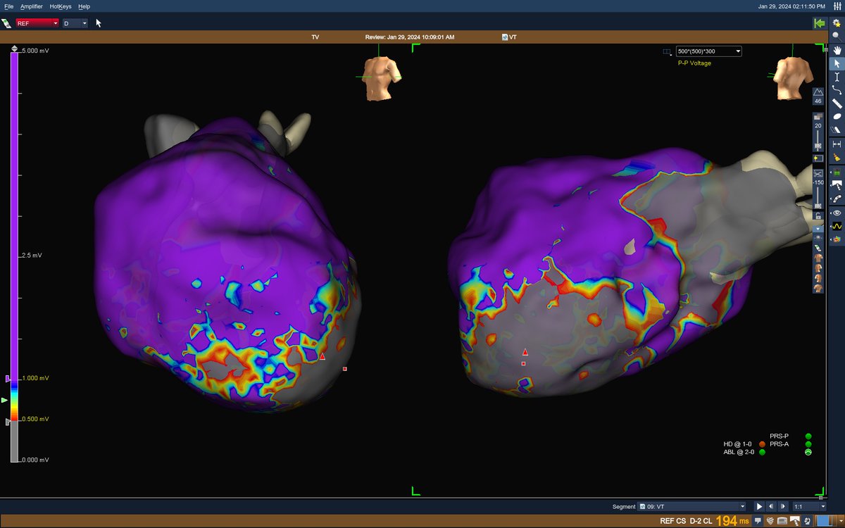 PSanchezSomonte's tweet photo. Starting Monday with a nice VT. Inferior scar. Hidden slow conduction unmasked with S3. Placement of HD grid in the isochronal crowding area records almost the entire diastolic pathway. Burning during VT(with diastolic potential in ablation cath)terminates it with the first shot! https://t.co/hDwRbGgeNc