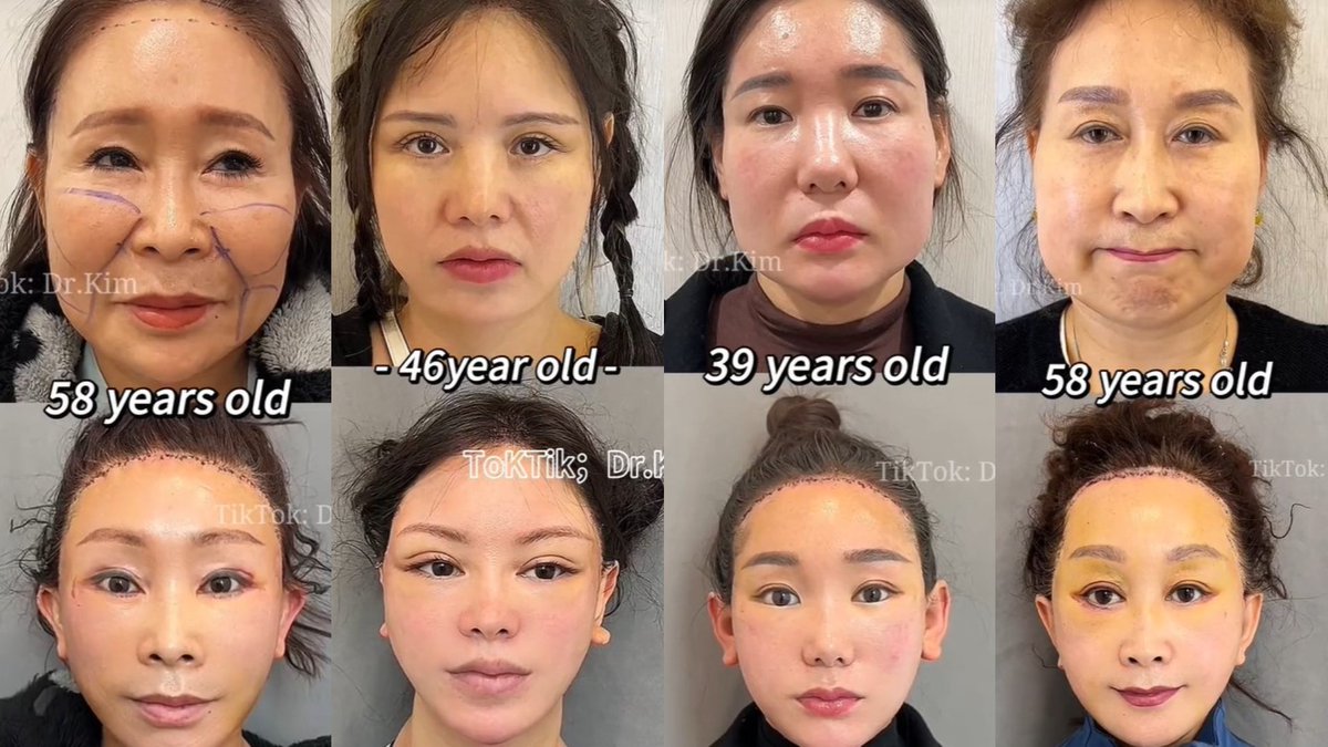 infobaemexico's tweet photo. ¿Quién es #DrKim, el cirujano cuyo rejuvenecimiento extremo horroriza y cautiva a usuarios de TikTok? 😖😱 https://t.co/WdHOdsURfI https://t.co/5UEFgsRO0Z