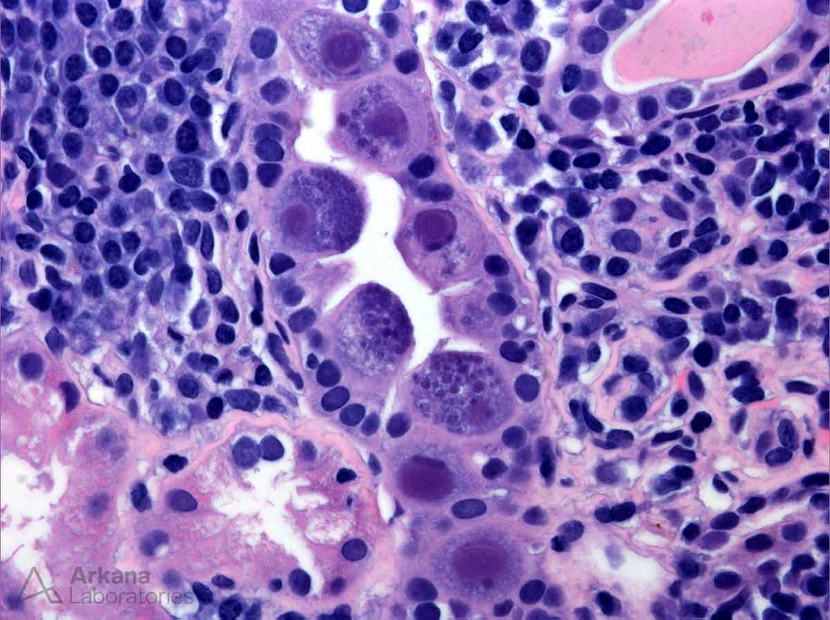 What stain would you order to clinch the diagnosis in this transplant patient with AKI? #DiagnoseThis