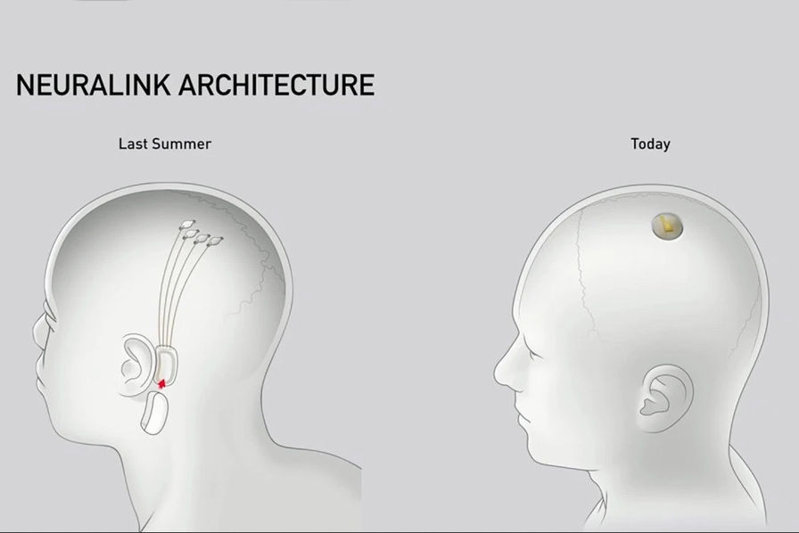 AlertesInfos's tweet photo. 🇺🇸 ALERTE INFO - Elon Musk annonce que le tout premier être humain a reçu un implant de Neuralink dans le cerveau. Il se porte bien. (X) https://t.co/v5iib2JpbQ