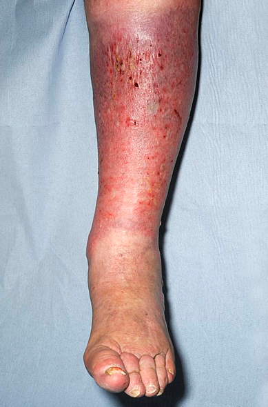 #TopTipTuesday Not all lower limb redness or skin colour changes point to cellulitis. Various conditions like eczema, DVT, haemosiderin staining, and contact dermatitis can have similar signs. The crucial factor is proper assessment for better patient outcomes!#Woundhealing #WWIC