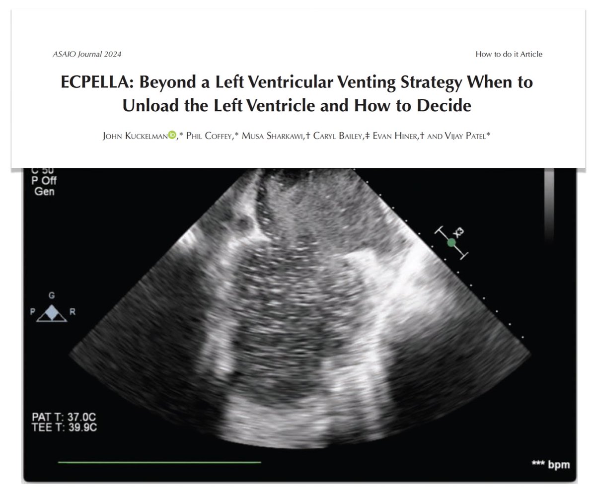 M Velia Antonini (@foamecmo) on Twitter photo Concomitant VA #ECMO & #Impella (= ECpella or ECMella) in cardiac arrest, #FOAMcc on <a href="/asaiojournal/">asaiojournal</a>
🔓 bit.ly/3SeqJsV
🩸 #ECPR +
🖥️ #TEE in ED for rapid decision-making (cannula positioning, assessment of cardiac function, guide EBF adjustments, confirm AV Concomitant VA #ECMO & #Impella (= ECpella or ECMella) in cardiac arrest, #FOAMcc on <a href="/asaiojournal/">asaiojournal</a>
🔓 bit.ly/3SeqJsV
🩸 #ECPR +
🖥️ #TEE in ED for rapid decision-making (cannula positioning, assessment of cardiac function, guide EBF adjustments, confirm AV