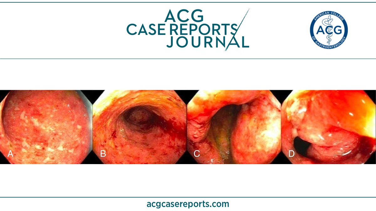 🔎 ACG Case Reports Journal 🔍

An Unusual Hiccup: Severe Singultus as a Symptom in Ulcerative Colitis
Anas Zaher, MD; Amneet K. Hans, MD &amp; Dana J. Lukin, MD, PhD, FACG
👉 bit.ly/42gZjqF

<a href="/A_KZaher/">Anas Zaher</a> <a href="/amneethansmd/">Amneet K. Hans, MD</a> <a href="/Dana_Lukin/">Dana Lukin MD, PhD</a> <a href="/KhushbooSGala/">Khushboo Gala</a> <a href="/VibhuC_MD/">Vibhu Chittajallu, MD, ABOM-D</a> #GIfellows