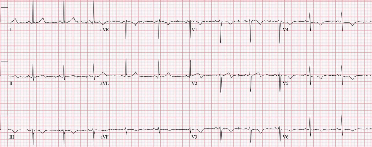 EM_RESUS's tweet photo. Here’s the #ECG of a 40-year-old woman with chest pain and shortness of breath that woke her up from sleep 
 
What’s her life-threatening diagnosis? https://t.co/YsvfJESMdJ