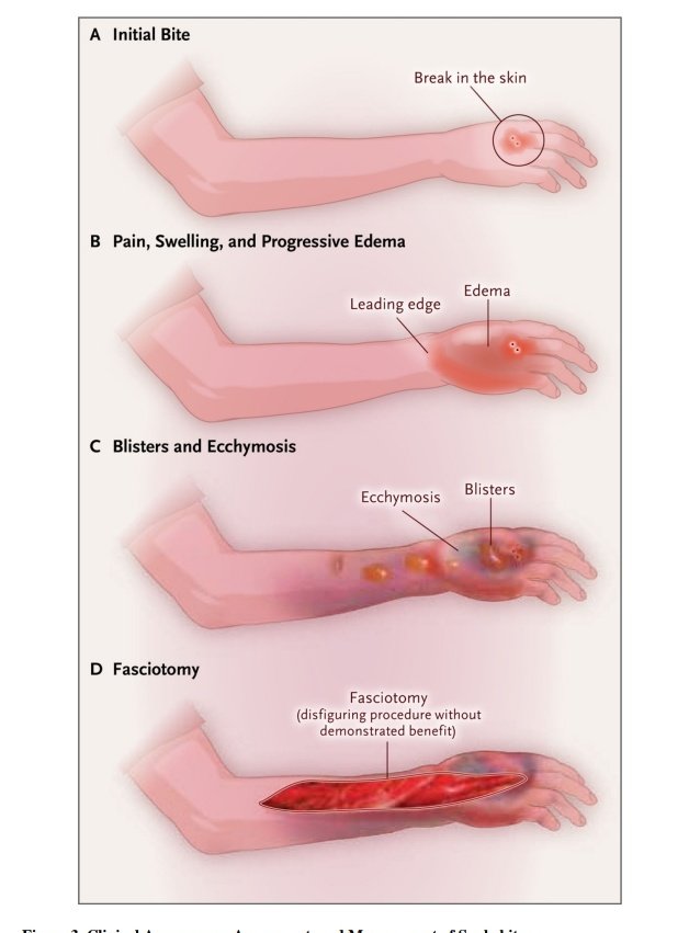 SOMELaguna's tweet photo. Envenenamiento por Serpientes 🐍😱

🔰📚N Engl J Med. 2022 

doi:10.1056/NEJMra2105228.

Enlace a Artículo Completo 👇🏼✅🆓 https://t.co/rPEDXf65lm https://t.co/l1f4w7QFdl