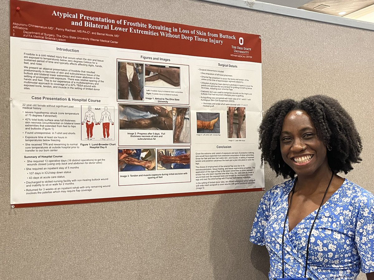 Great job Chidinma on her poster presentation @MauiJab #jabmaui. What to show off The Ohio State University Comprehensive Burn Center and Plastic Surgery Collaboration @OSUWexMed