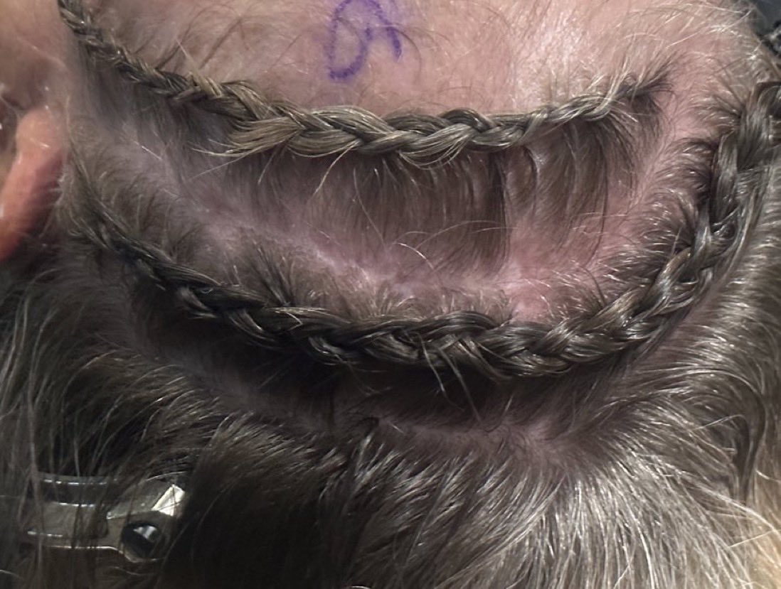 Oren Gottfried, MD (@ogdukeneurosurg) on Twitter photo Many brain surgeons enjoy BRAIDING their patients hair to avoid the classic head shave as patients deserve kind gestures during scary times. Credit: <a href="/PeterNakajiMD/">Peter Nakaji MD</a> <a href="/ARODMDPHD/">Analiz Rodriguez MD, PhD, MBA, FAANS</a> Many brain surgeons enjoy BRAIDING their patients hair to avoid the classic head shave as patients deserve kind gestures during scary times. Credit: <a href="/PeterNakajiMD/">Peter Nakaji MD</a> <a href="/ARODMDPHD/">Analiz Rodriguez MD, PhD, MBA, FAANS</a>