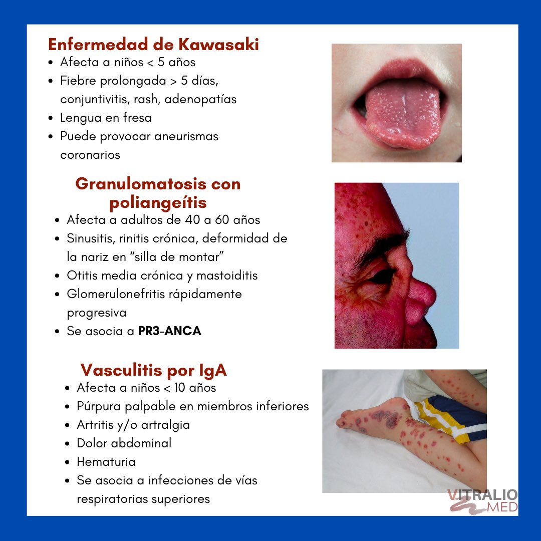 gen110299's tweet photo. Vasculitis cortesía de la cuenta de Instagram @vitraliomed 
#vasculitis https://t.co/4fpQxukOqM