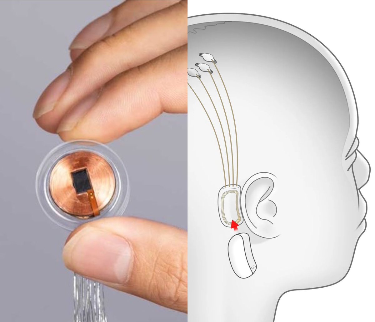 PopBase's tweet photo. Elon Musk announces that the first human has received a brain implant from his startup Neuralink. https://t.co/HAL1oj6blu