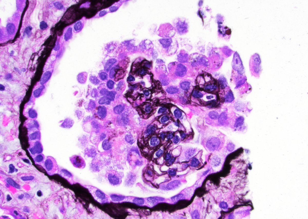 A case of DENGAN (dengue nephropathy) <a href="/JeanHouMD/">Jean Hou, MD</a> 
Patient had severe proteinuria &amp; ARF 
Bx showed collapsing glomerulopathy...
pubmed.ncbi.nlm.nih.gov/31198534/