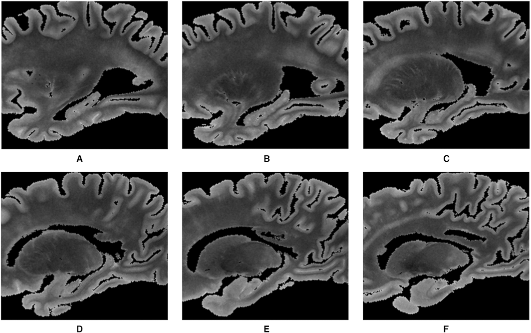 JAHA (@jaha_aha) on Twitter photo The association of intracranial atherosclerosis pathology with hippocampal volumes: findings from community-based studies. <a href="/Alifkapasi1/">Alifiya Kapasi</a> #AHAJournals ahajrnls.org/48QVSJL The association of intracranial atherosclerosis pathology with hippocampal volumes: findings from community-based studies. <a href="/Alifkapasi1/">Alifiya Kapasi</a> #AHAJournals ahajrnls.org/48QVSJL
