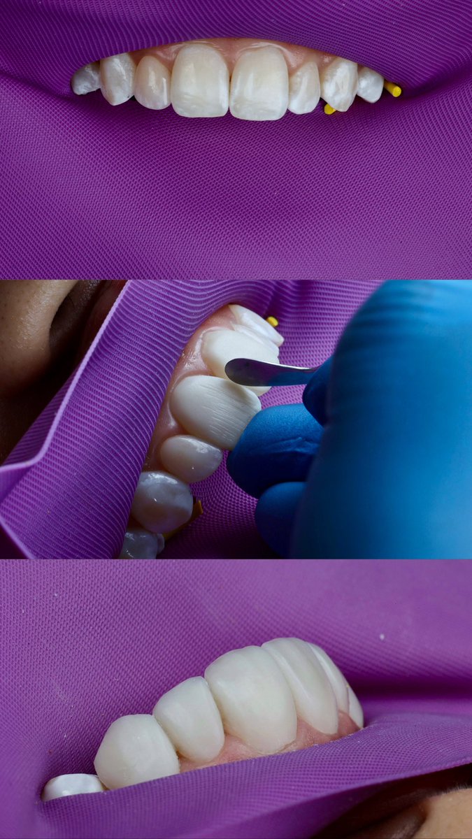 Mariacduques's tweet photo. Hace mucho no aparecía por acá pero hoy tengo un motivo inmenso: Ver la evolución de mi trabajo es orgullo y el de hoy si que más 😮‍💨😍👩🏼‍⚕️🦷 https://t.co/g4pF63BOYo