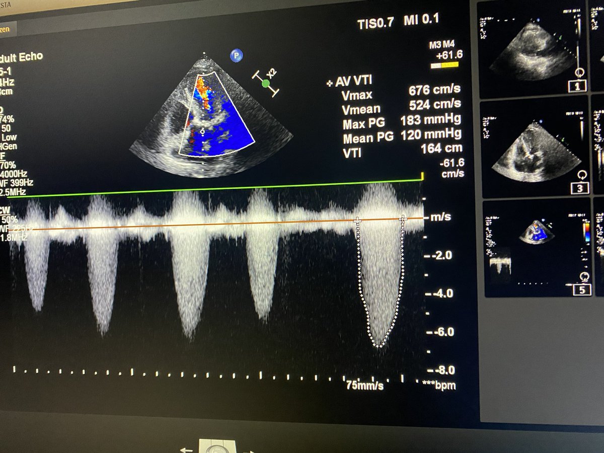 #echofirst no ecg available .. Which gradient need to mention ? #Cardiotwitter #EchoOfTheHorizon