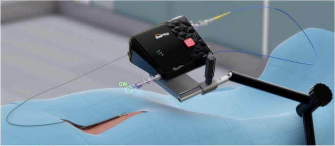 cvirendo's tweet photo. In this study, the safety and feasibility of a novel robotic system in an in vivo porcine vascular model was assessed

Read more for info on technical success, complications + accuracy of robotic-assisted navigation:
https://t.co/5UJqOBTxAB #IRad

@StavrosSpiliop3 @NAArkoudis https://t.co/zc6Mxdn7sH