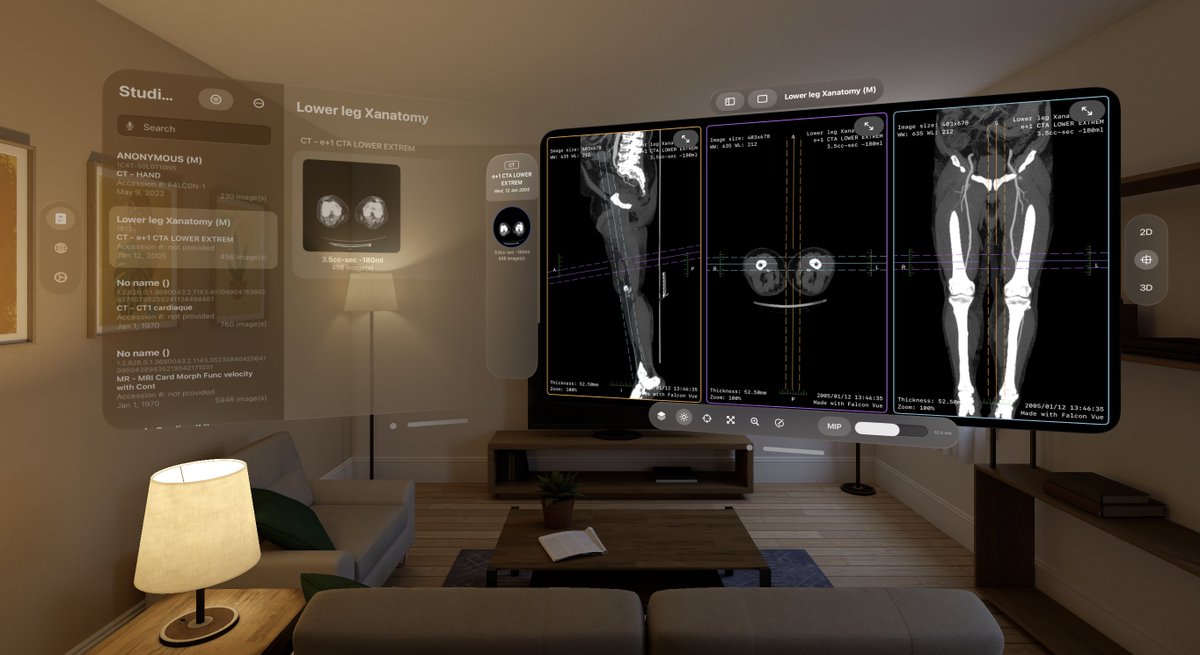 falcon_vue's tweet image. 🌞 Embrace the future with Falcon Vue, for Apple Vision Pro. Witness medical imaging like never before! #falconVue #MedicalImaging #Innovation #AppleVisionPro