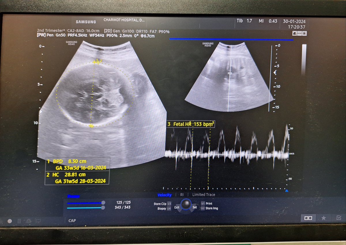 Being a medical officer, doing screening antenatal scan has significant role in providing standard of care &amp; timely referral at rural setting where radiologist &amp; mdgp are not available.
I feel privileged to be a part of team providing such services &amp; contributing to rural health