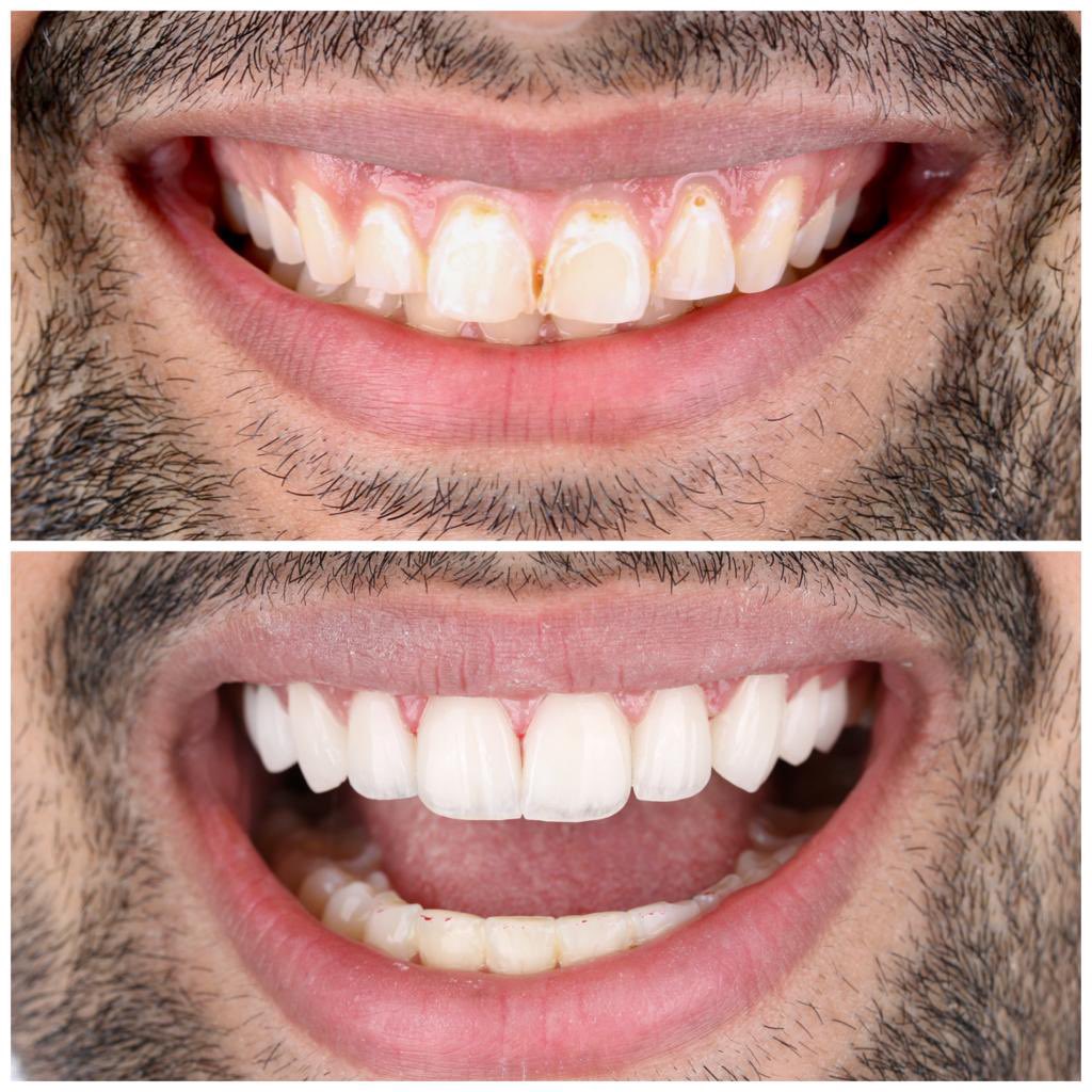 sn_clinic's tweet photo. تم استخدام قشرات الايماكس التجميلية لرسم الابتسامة

لحجز مواعيد التركيبات الاتصال على 180111

.
#اسنان #الاسنان #ابتسامة #التجميل #الابتسامة_التجميلية https://t.co/JLb42DHd1U