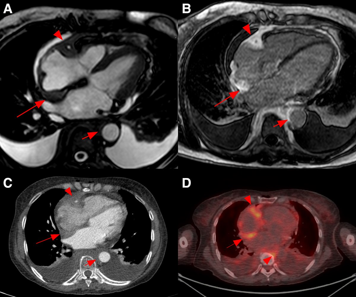 Vladyslav Kavalerchyk 🇺🇦 (@echo_stepbystep) on Twitter photo Multimodality evaluation of pseudo-tumoural atrial wall thickening #EHJCVI #ErdheimChesterdisease
André Vaz et al. ☑️bit.ly/47UPobx
<a href="/EACVIPresident/">EACVI President</a> <a href="/iamritu/">Ritu Thamman MD</a> <a href="/LopezOpitz/">J.Lopez-Opitz@CardioImagen_cl</a> <a href="/purviparwani/">Dr. Purvi Parwani</a> <a href="/ecocardio_cl/">Julián Vega Adauy</a> <a href="/JGrapsa/">Julia Grapsa MD, PhD</a> <a href="/VDelgadoGarcia/">Victoria Delgado</a> <a href="/denisamuraru/">Denisa Muraru</a> <a href="/alessia_gimelli/">Alessia Gimelli</a> <a href="/alcantaramonica/">Monica Alcantara M.D. , MSc, FESC, FEACVI</a> Multimodality evaluation of pseudo-tumoural atrial wall thickening #EHJCVI #ErdheimChesterdisease
André Vaz et al. ☑️bit.ly/47UPobx
<a href="/EACVIPresident/">EACVI President</a> <a href="/iamritu/">Ritu Thamman MD</a> <a href="/LopezOpitz/">J.Lopez-Opitz@CardioImagen_cl</a> <a href="/purviparwani/">Dr. Purvi Parwani</a> <a href="/ecocardio_cl/">Julián Vega Adauy</a> <a href="/JGrapsa/">Julia Grapsa MD, PhD</a> <a href="/VDelgadoGarcia/">Victoria Delgado</a> <a href="/denisamuraru/">Denisa Muraru</a> <a href="/alessia_gimelli/">Alessia Gimelli</a> <a href="/alcantaramonica/">Monica Alcantara M.D. , MSc, FESC, FEACVI</a>
