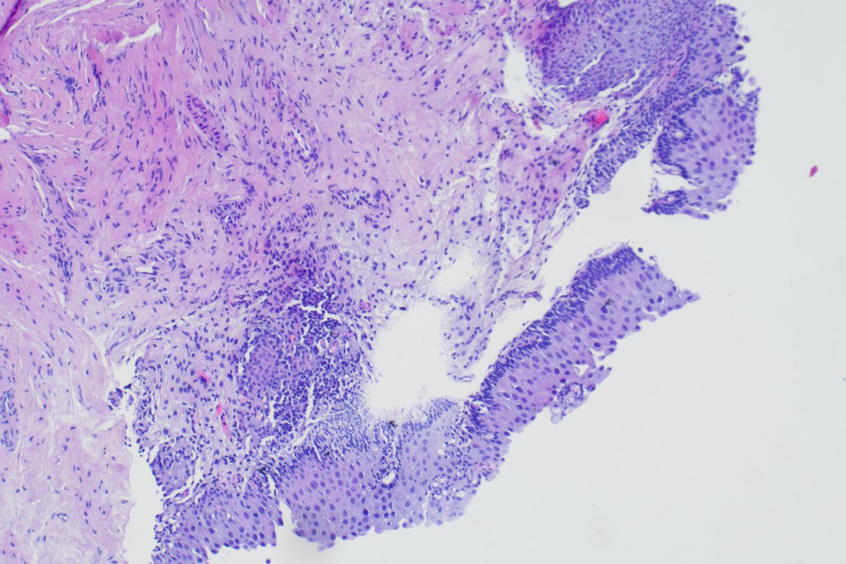 Bladderbiopsie, what do you think? #GUpath