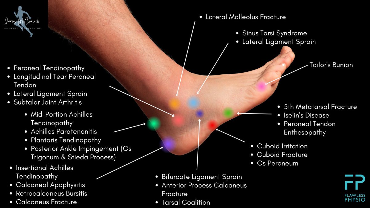 Flawless_Physio's tweet photo. Foot Pain Charts https://t.co/F4MzHqDhs8