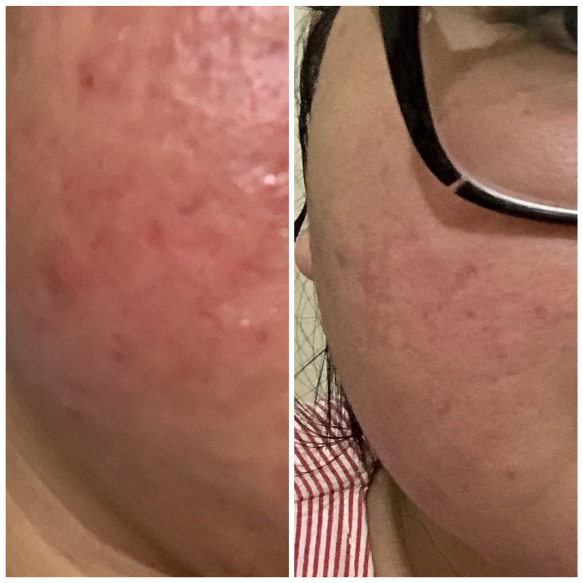 elsa. dry skin✨ tweet media