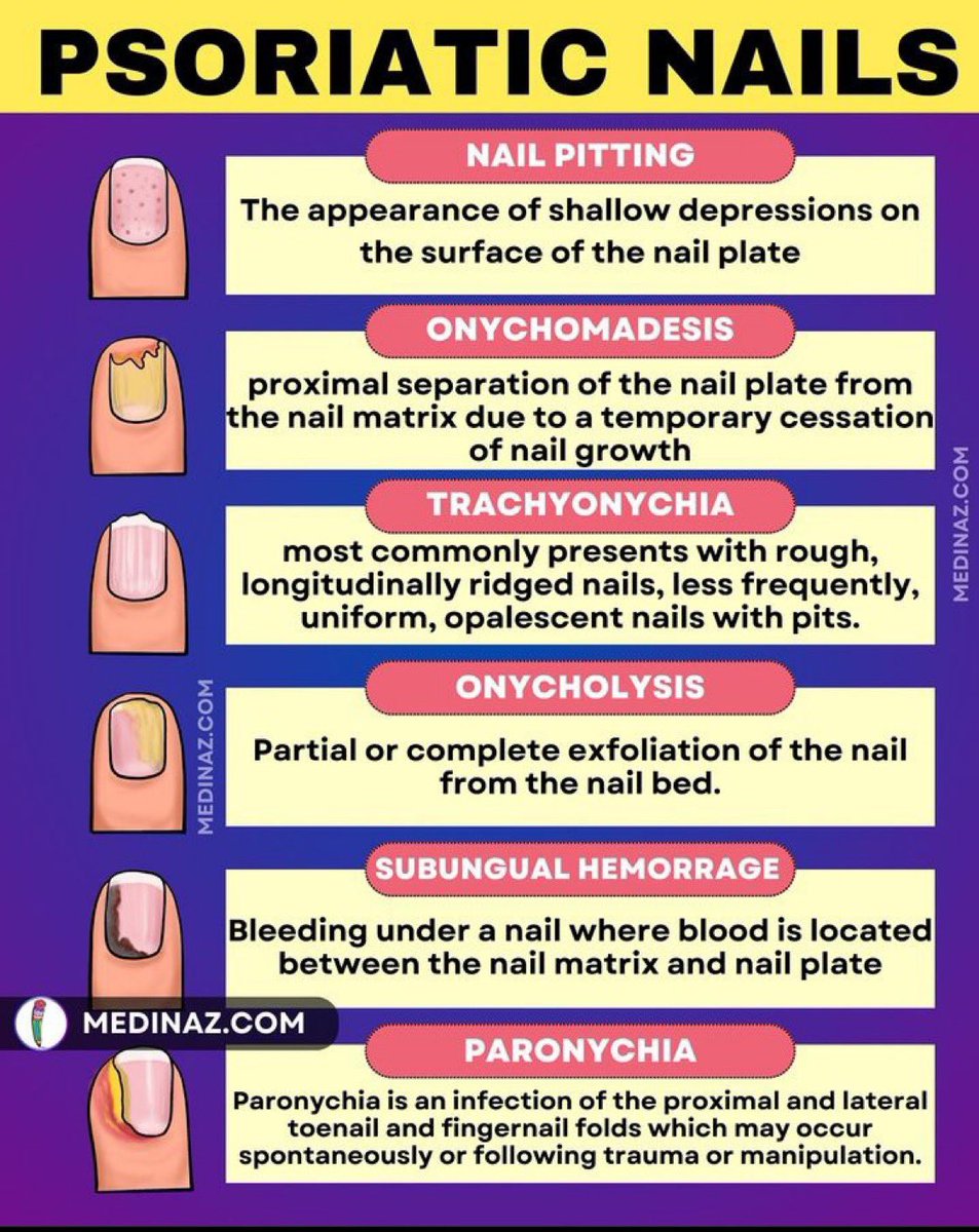 Psoriatic nails : Point to Remember