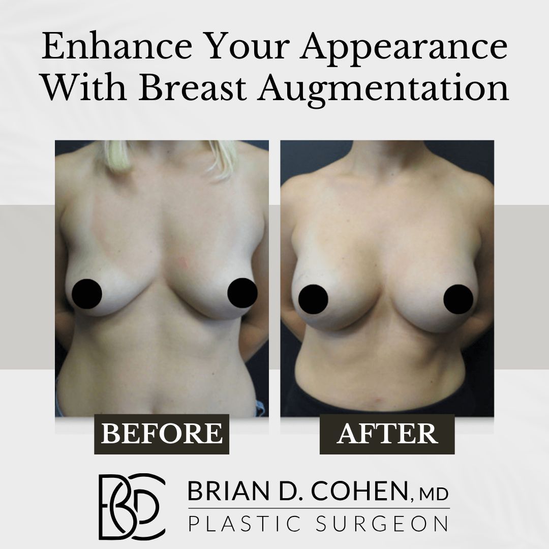 CohenPlasticNY's tweet photo. Enhance your #confidence and curves with #BreastAugmentation at #CohenPlasticSurgery! Our expert surgeon tailors each procedure to achieve your desired #shape and #size, ensuring natural-looking and personalized #results. Learn more:

https://t.co/tmJV441zap

#GreatNeck https://t.co/zX8A5muP1d