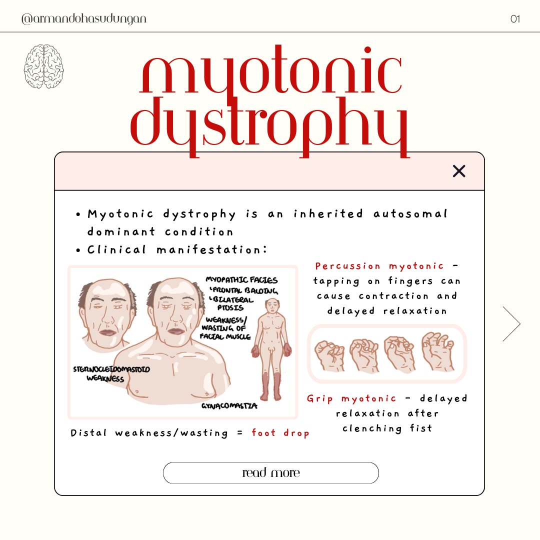 armandohasudung's tweet photo. Myotonic dystrophy is an inherited autosomal dominant disorder. There are two types of myotonic dystrophy and both can cause a variety of complications.
Watch the full video here: https://t.co/Lx5k14qyqG
.
.
.
#Armando #myotonicdystrophy #medicalnotes https://t.co/M8rNpDyplV