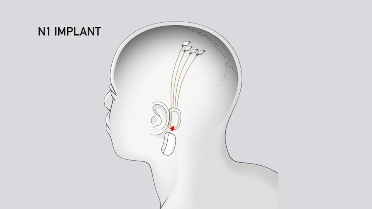 consequence's tweet photo. Elon Musk's brain chip company Neuralink has implanted its first device in a live human being.

Musk says his brain chip will allow humans to communicate without talking, listen to music simply by thinking of a song title, and treat mental health issues.

→ https://t.co/3TJouTur23